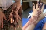 black henna side effects, allergic reaction to henna hair dye, henna tattoo cause aussie woman to almost lose her hand, Aswan