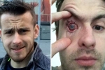 why can't you wear contact lenses in the shower?, lens in shower, contact lens wearers beware man goes blind after parasites eat man s eye as he wore lenses in shower, Cornea