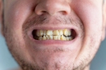 Nicotine stains teeth, Nicotine stains, are nicotine stains on your teeth irreversible, Enamel Nicotine stains teeth, Nicotine stains, are nicotine stains on your teeth irreversible, Enamel
