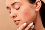 acne, skin care products, 10 ways to get rid of pimples at home, Skincare