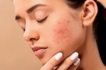 dermatologist, skin care, 10 ways to get rid of pimples at home, Dandruff