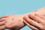 Monkeypox research, Monkeypox latest updates, study says that the symptoms of monkeypox are different from earlier, Monkeypox