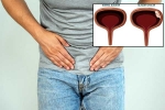 Bladder Cancer reasons, Bladder Cancer articles, why is bladder cancer common in men, Unhealthy eating habits