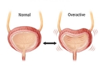 Overactive Bladder prevention, Overactive Bladder prevention, here are some warning signs of an overactive bladder, Overactive bladder